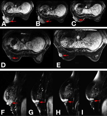 Case Report: Effective Treatment With Pyrotinib and Capecitabine in a Heavily Pretreated Locally Advanced Breast Cancer Harboring Both HER2 Overexpression and Mutant